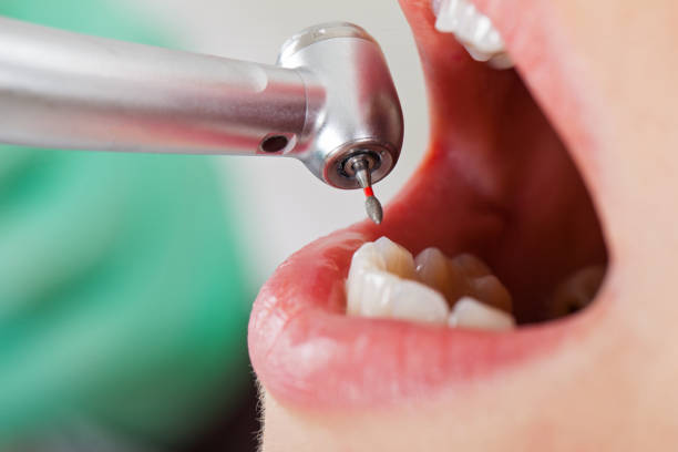 Best Emergency Dental Care for Broken or Chipped Teeth in Bluefield, WV